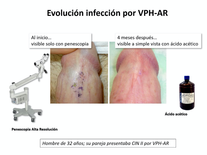 VPH (Cuernavaca -cdmx) virus papiloma humano apoyo y tratamiento