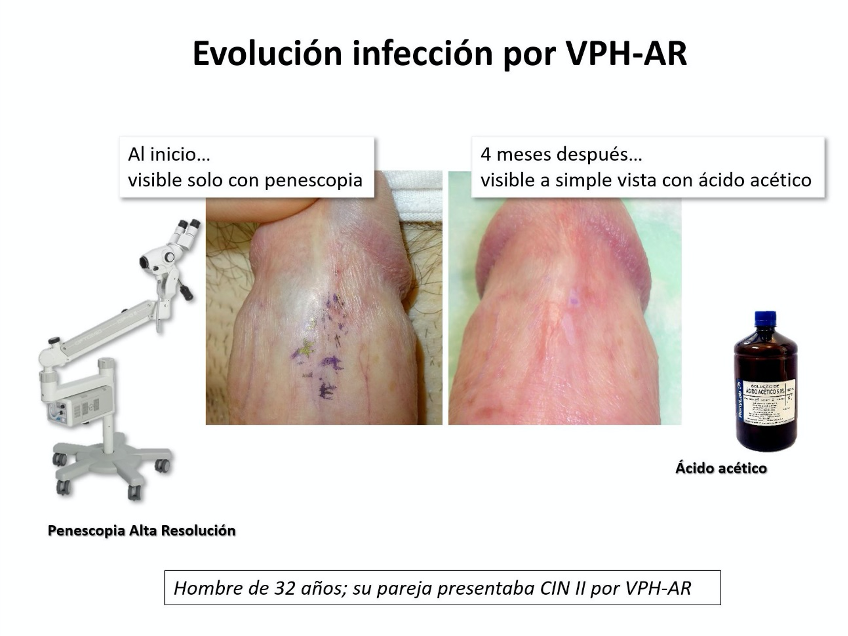 virus papiloma en hombres