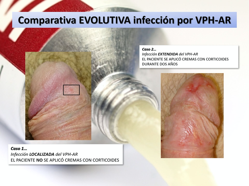 Hpv virus en hombres. Tratamiento para virus papiloma humano en hombres