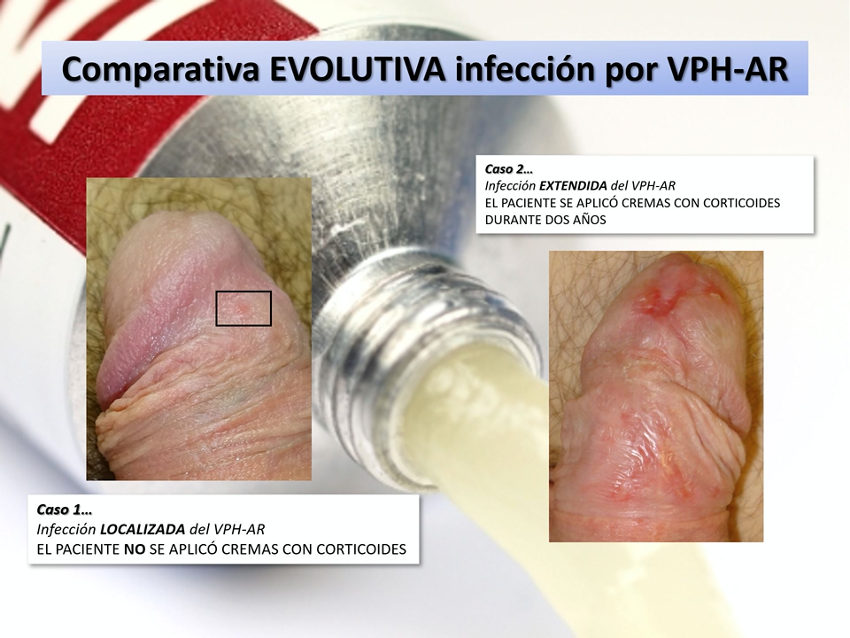 Se puede tener hpv en el ano